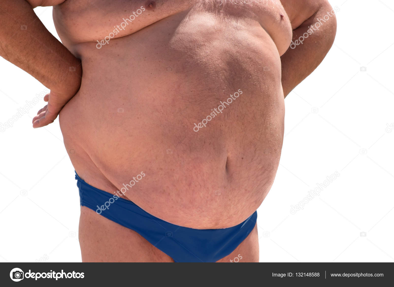 Que es una hernia en la barriga