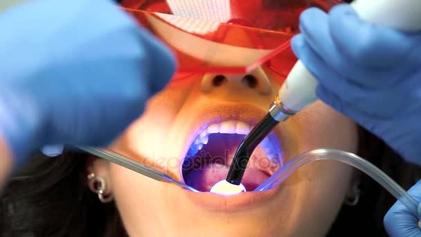 Zubař používá vytvrzovacího světla. — Stock video