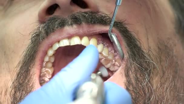 치과 의사는 치아를 청소 한다. — 비디오