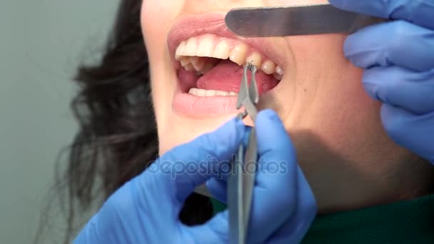Zuby a závorka. — Stock video