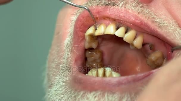 Mauvaises dents du patient dentaire . — Video