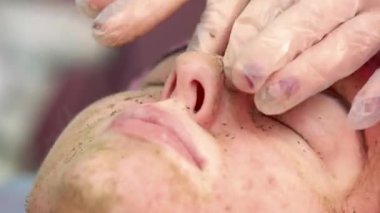 Sorunlu yüz cildi, kozmetik prosedür.