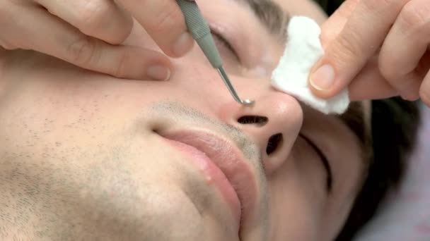 Cara blackheads remoção close up . — Vídeo de Stock