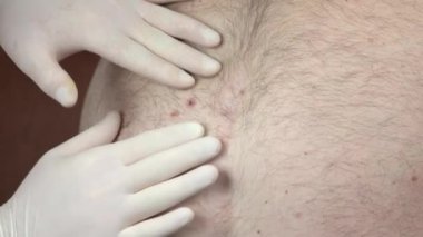 Doktor dermatolog hastanın doğum lekesini inceliyor..