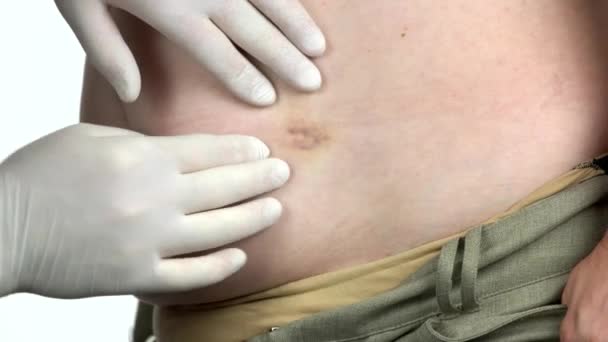 Γιατρός με γάντια εξετάζει ένα σημείο στην κοιλιά ενός ατόμου. — Αρχείο Βίντεο