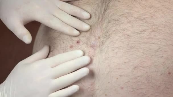 Médico dermatologista examina marca de nascença do paciente . — Vídeo de Stock