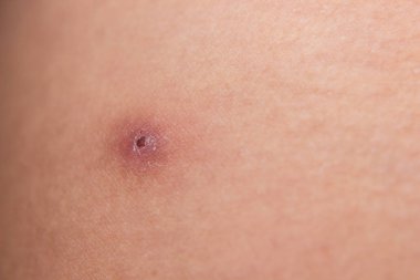 Deri lezyonu ile görüntüyü