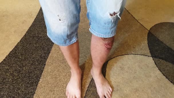A 남자의 다리에 상처입니다. 응급 처치 — 비디오