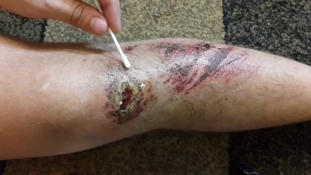 Une blessure à la jambe d'un homme. Premiers secours — Video