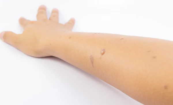 Blisters on skin arm — Stock Photo, Image
