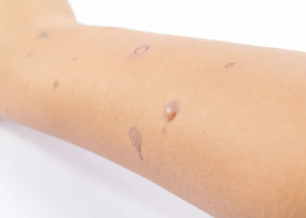 Blisters on skin arm