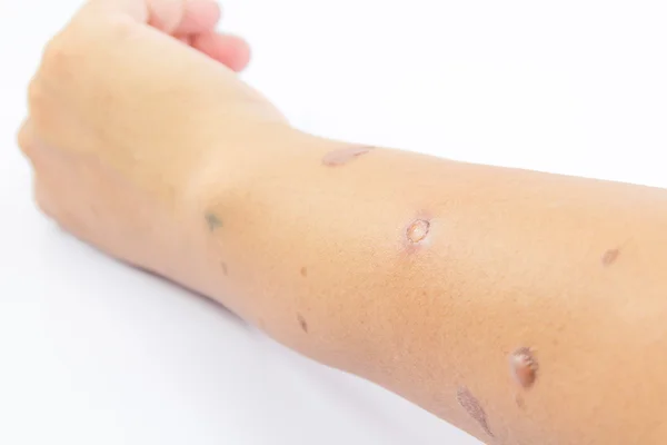 Ampollas en el brazo de la piel — Foto de Stock