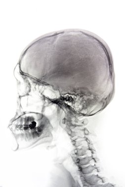 Film x-ışını kafatası ve Servikal Omurga yan görünüm