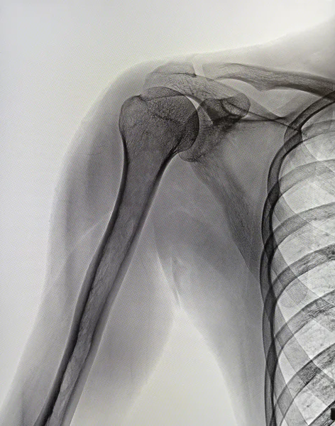 X-rays image of the painful or injury shoulder joint, shoulder dislocation. Medicine