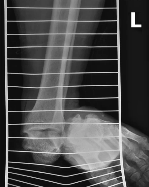 Immagine a raggi X di una caviglia slogata . — Foto Stock