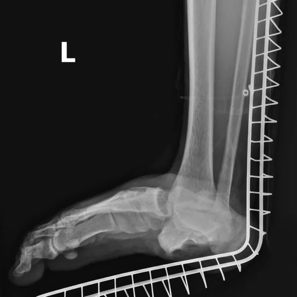 Imagen de rayos X de la dislocación articular del pie izquierdo . — Foto de Stock