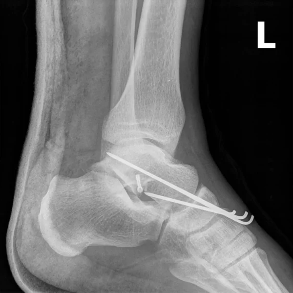 X 射线光学元件连接损坏的踝关节. — 图库照片