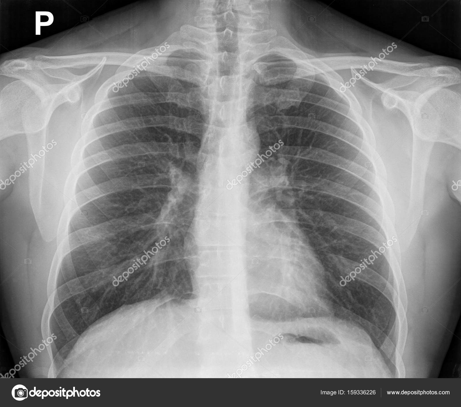 X-ray image of the chest showing the internal anatomy of the rib Stock ...