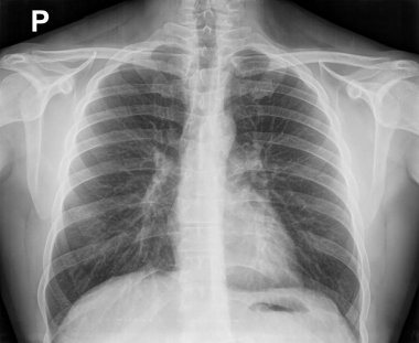 Kaburga iç anatomisi gösterilen göğüs X-Ray görüntüsü