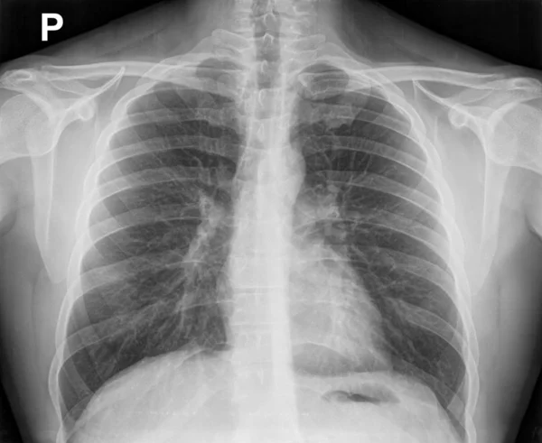 Imagen radiográfica del tórax que muestra la anatomía interna de la costilla Imagen De Stock