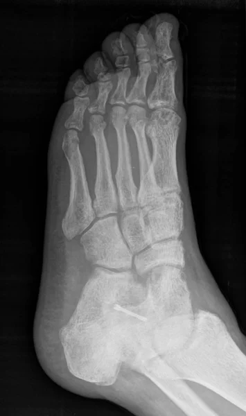 Harbert fixation de la fracture par vis - rayons X . — Photo
