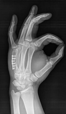 X-ray of human hand. V metacarpal bone with implant. clipart