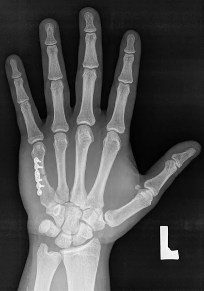 Raggi X della mano sinistra. V osso metacarpale con impianto . — Foto Stock