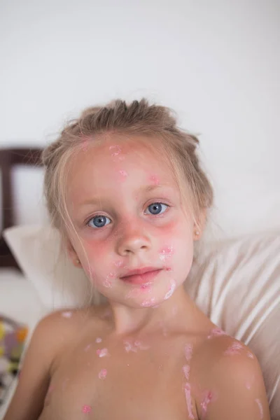 The cute little girl is sick with chickenpox. The face is covered with pimples.