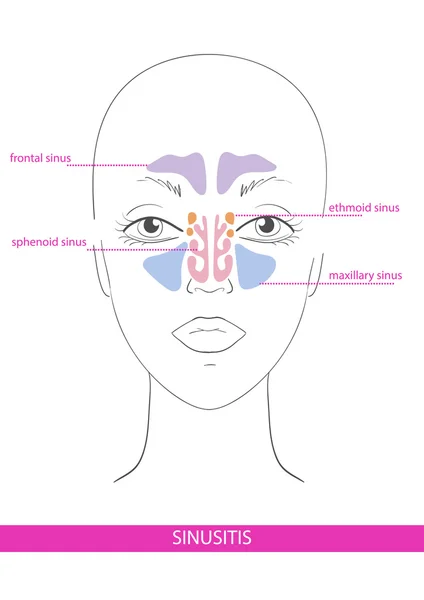 Seno nasal. inflamación — Archivo Imágenes Vectoriales