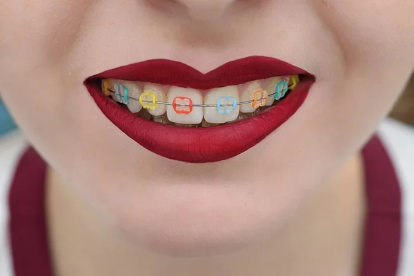 Crooked lips with white teeth — Stock Photo, Image