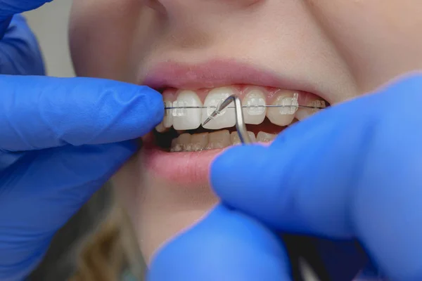 tıkanıklığı hastalara diş telleri ile düzeltilmesi