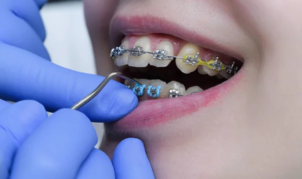 parantez içinde ağız boşluğu fiksasyonu