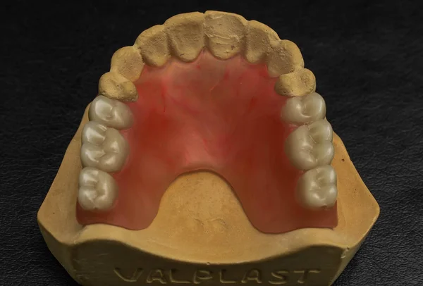 bir protez dişsiz çenesine örneği