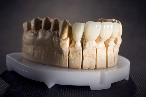Стоматология. Модель челюсти человека с имплантированными зубами — стоковое фото