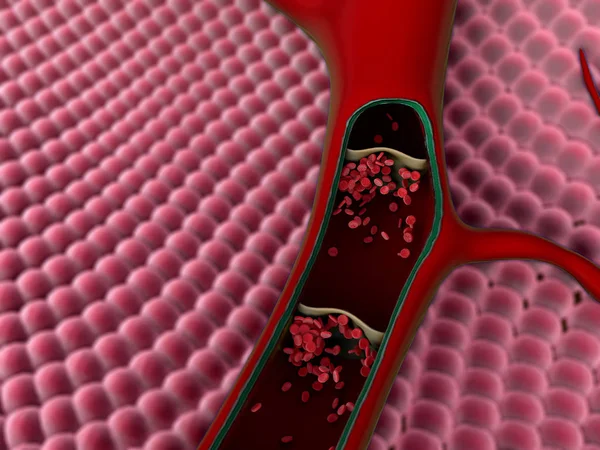 damarlarında kan pıhtısı