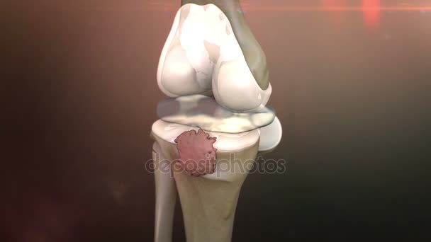 Animering av mänskliga knä sjukdom — Stockvideo