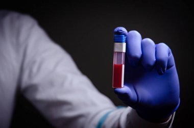 Doktorun elinde bir koronavirüs var. Salgın virüsünün tedavisinde kullanılan Covid-19 tıp eldiveni konseptini içeren bir kan testi.