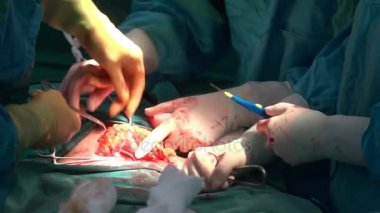 Ameliyat ekibi sezaryen ameliyatı operasyonu.