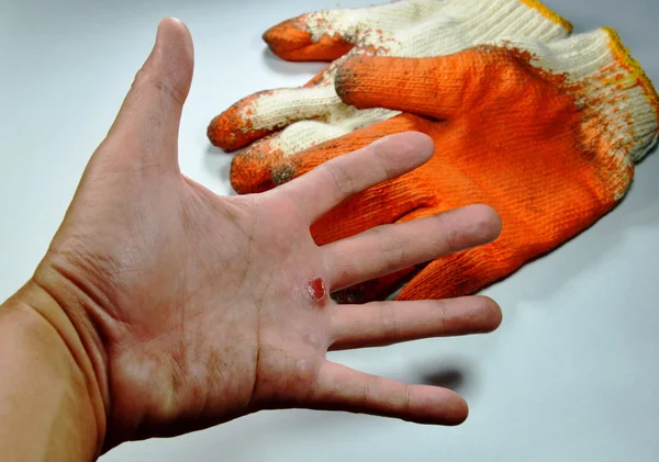 Blister on hand because do not wear safety glove — Stock Photo, Image