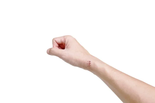 Mano con cicatriz de sutura después de la cirugía sobre fondo blanco — Foto de Stock