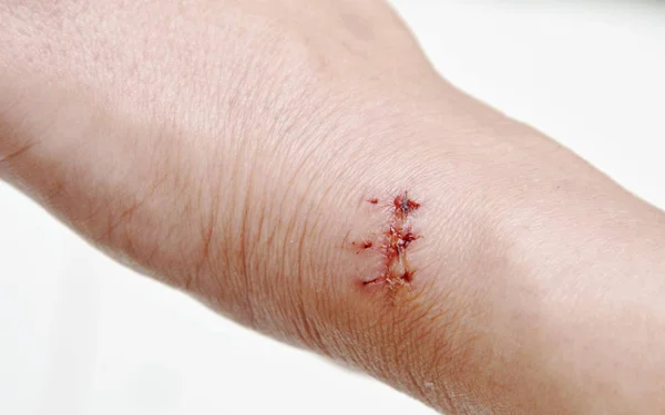 Mão com cicatriz de sutura após a cirurgia em fundo branco — Fotografia de Stock