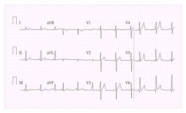 Kalp kardiyogram grafik vektör. Dalga formu kontrol EKG grafik üzerinde Illustration. Kalp Ritim, iskemi, enfarktüs. Canlılık kalp atışı