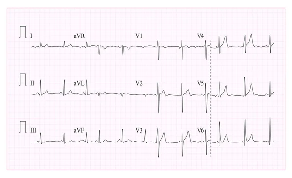 Hart Cardiogram grafiek Vector. Illustratie van Wave vorm op geselecteerde Ecg grafiek. Hart ritme, ischemie, infarct. Vitaliteit Heartbeat — Stockvector