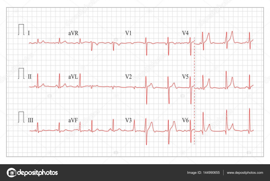 Healthy Heart Beat Chart