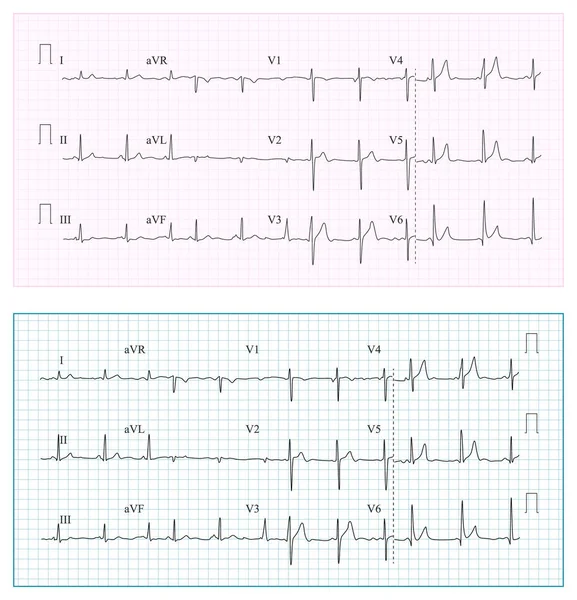 Heart Cardiogram Chart Vector. Set Healthy Heart Rhythm, Ischemia, Infarction. Vitality Heartbeat, Heart Electrocardiogram, Pulse Line — Stock Vector