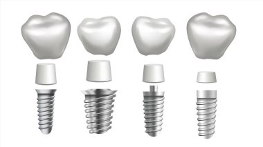 Dental Implant vektör ayarlayın. Diş seti. Diş sağlığı. Stomatology diş hekimliği. Tasarım beyazlatma. Gerçekçi izole illüstrasyon