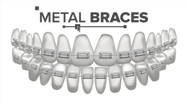 Metal Braces Vector. Mandíbula Humana. Aparelhos nos dentes. Sorria com aparelho. Ilustração isolada realista 3D —  Vetores de Stock