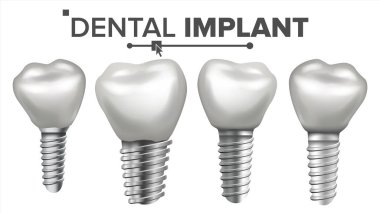 Dental Implant vektör ayarlayın. Yapısı implant. Taç, ayağına, vida. Bakım, Stomatology. Gerçekçi izole illüstrasyon