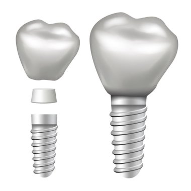 Dental Implant vektör. Yapısı implant. Taç, ayağına, vida. Gerçekçi izole illüstrasyon