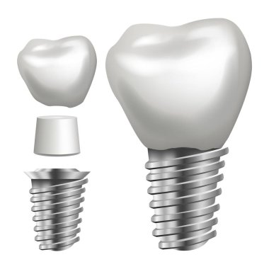 Dental Implant vektör. Yan görünümü. Grafik tasarım öğesi. Diş yapıştırma Poster. Gerçekçi izole illüstrasyon